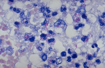Slide Of T.B
