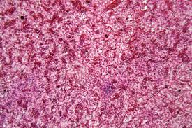 Slide Of Human Cancerous Liver Cells